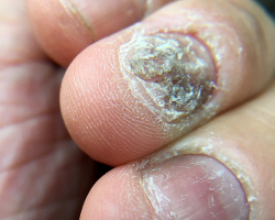 Nail Psoriasis Treatment
