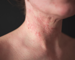 Seborrheic Dermatitis Treatment