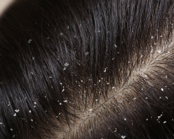 Dandruff & Scalp Treatment