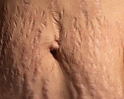 Scar & Stretch Mark Reduction