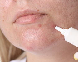 Advanced Acne & Scar Treatment