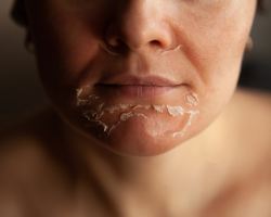 Customized Combination Peels for Skin Rejuvenation