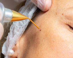 Facial Warts Removal