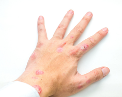 Inverse Psoriasis Treatment