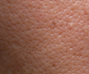 Open Pores & Oil Control Therapy