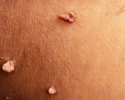 Wart Recurrence Prevention Therapy