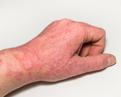 Allergic Dermatitis Treatment