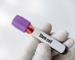 Stem Cell-Boosted Hair Therapy