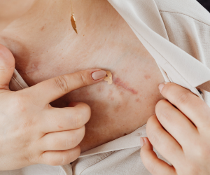 Scar-Free Tattoo Removal Treatments