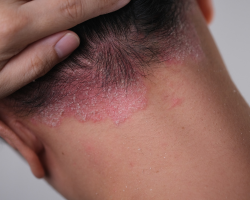 Scalp Psoriasis Treatment