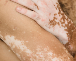 Pigmentation & Dark Spot Correction