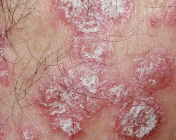 Psoriasis Maintenance & Recurrence Prevention Therapy