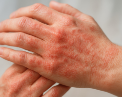 Chronic Dermatitis Care & Prevention