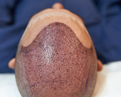 Scalp Micropigmentation