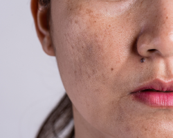 PRP for Pigmentation & Dark Spots