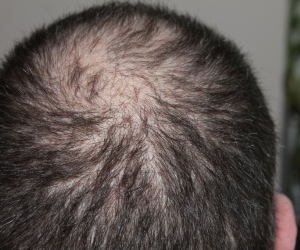 PRP for Hair Regrowth