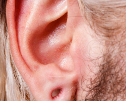 Torn Ear Lobe Repair