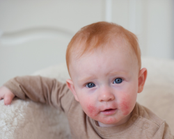 Atopic Dermatitis Treatment