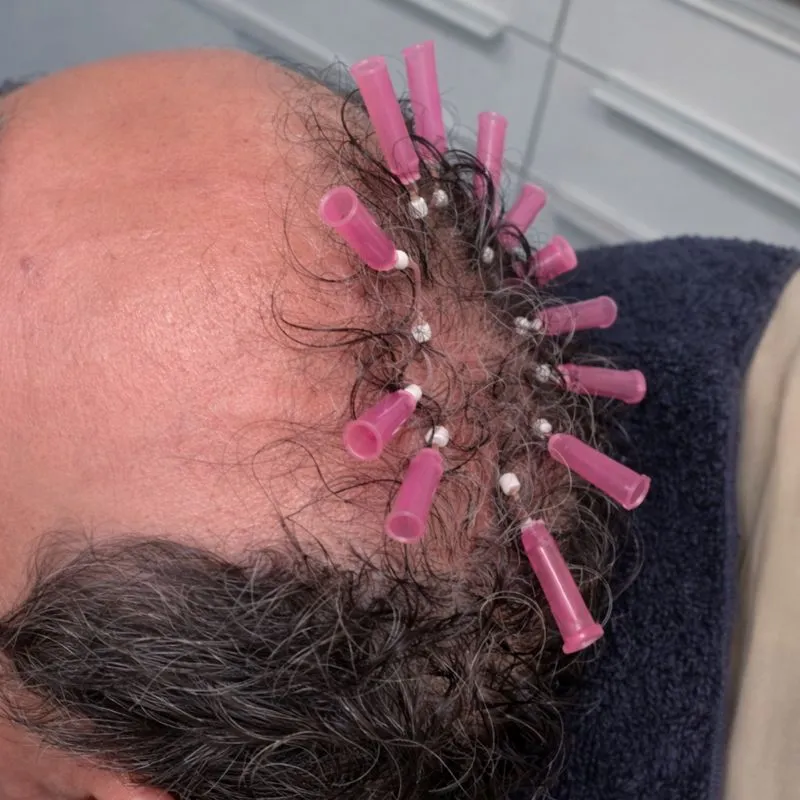 Best hair clinic in Chennai