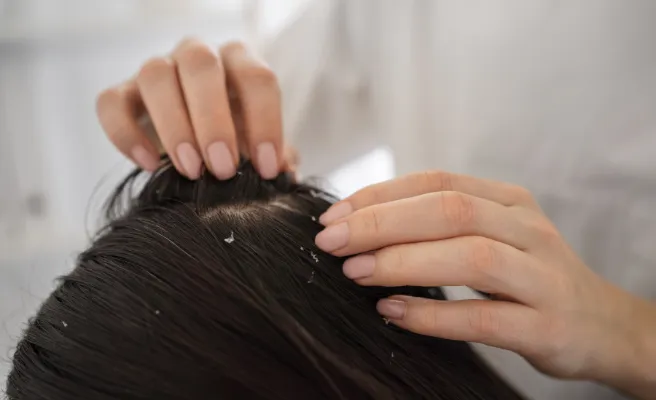 Anti Dandruff Treatment