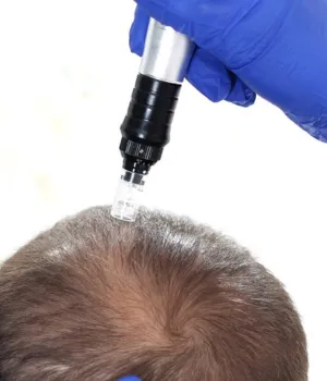 Best Hair Care Clinic in Chennai