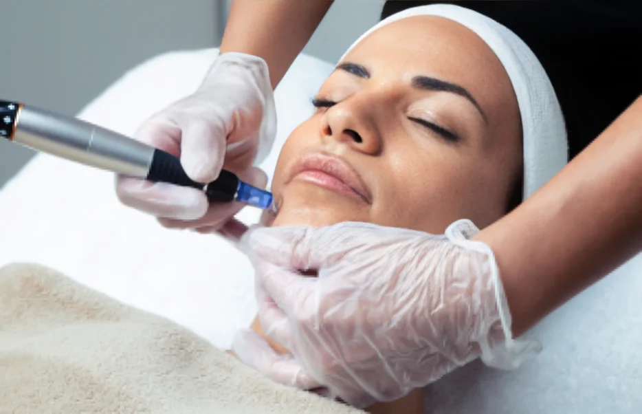 Microneedling