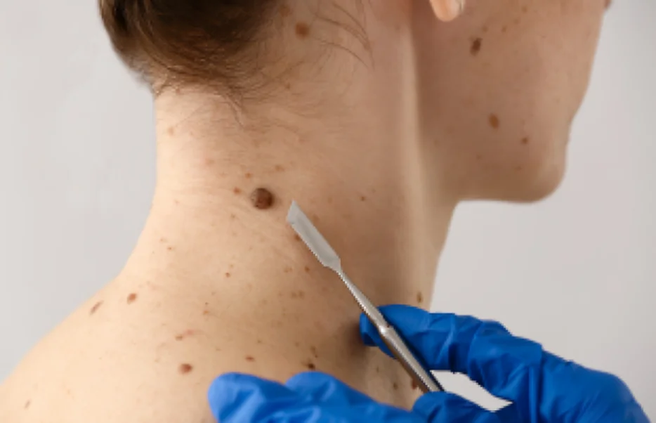 Mole Removal