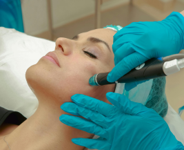 Carbon Laser Facial